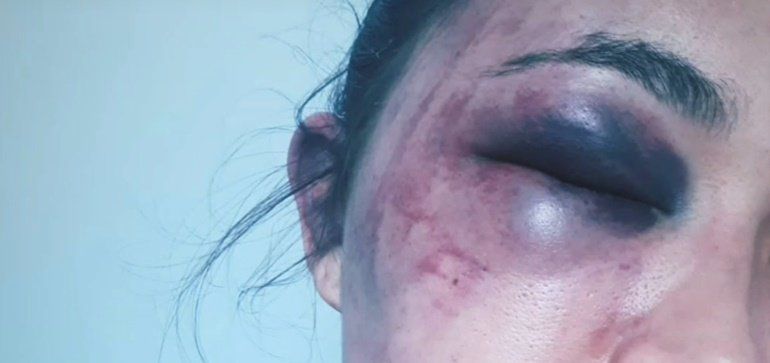 Una lanzaroteña denuncia una brutal agresión de su pareja en el País Vasco: "Si no salto por la ventana, me mata"
