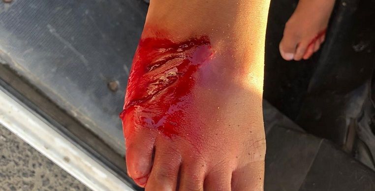 Susto en Famara: un niño recibe 20 puntos por las heridas causadas por un animal cuando se bañaba