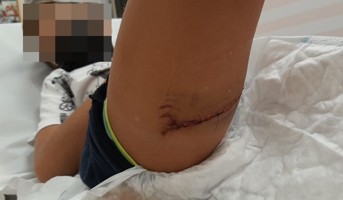 Herida de la mordedura del perro al menor en San Francisco Javier