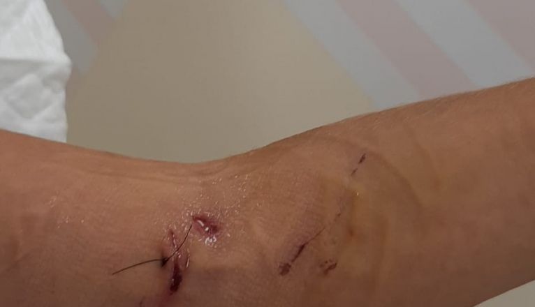 Heridas en el brazo del menor, producidas por uno de los rottweiler Heridas en el brazo del menor, producidas por uno de los rottweiler