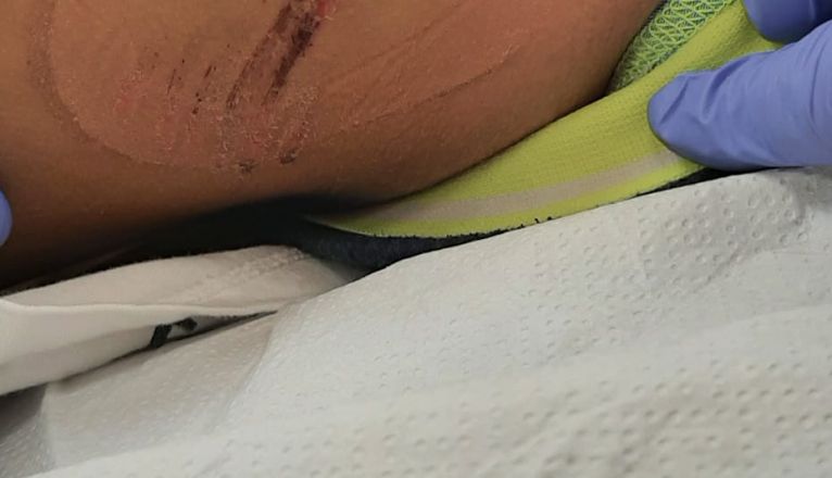 Tercera de las heridas del menor, en uno de los costados Tercera de las heridas del menor, en uno de los costados