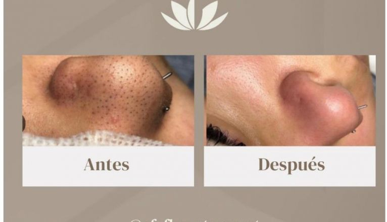 Efectos de Hydrofacial Efectos de Hydrofacial