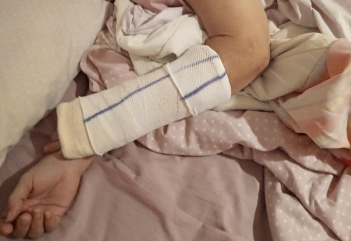 Brazo escayolado de la vecina de Arrecife