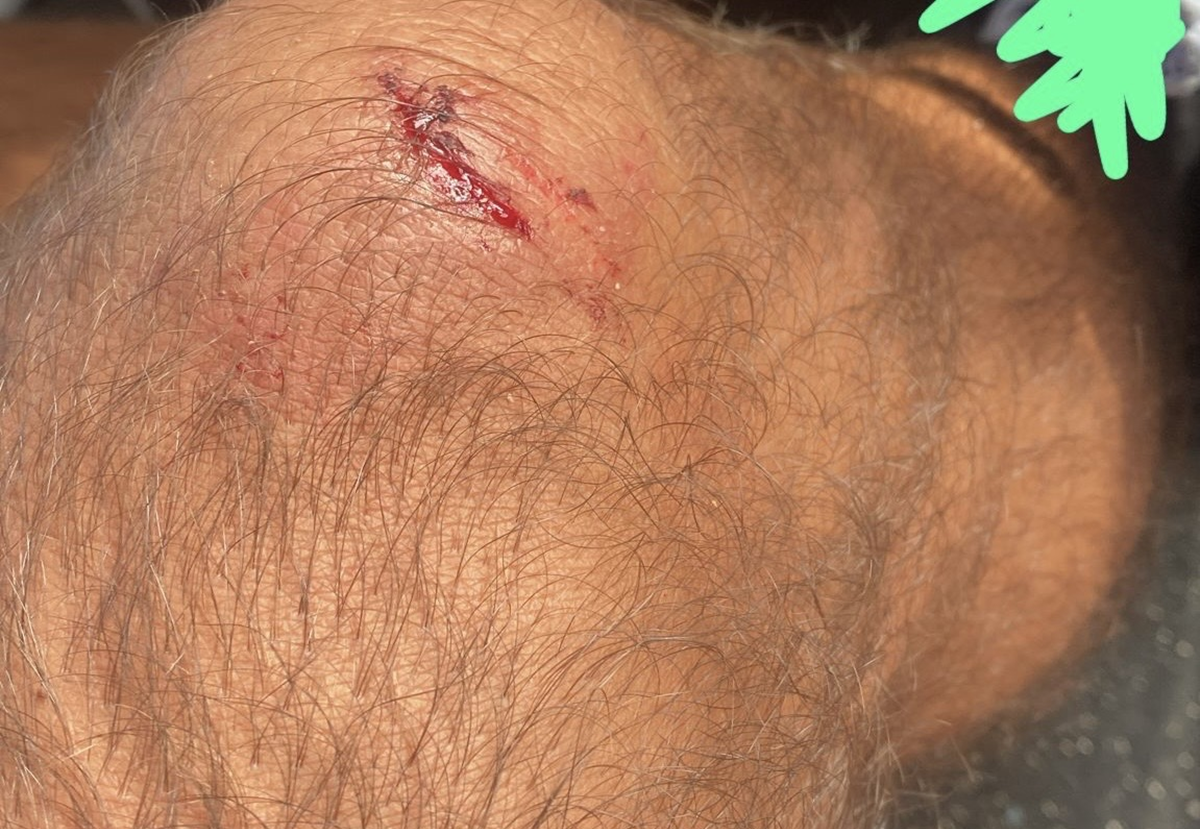 Una de las heridas ocasionadas por la presunta agresión Una de las heridas ocasionadas por la presunta agresión