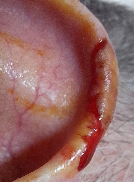 Wound on the ear