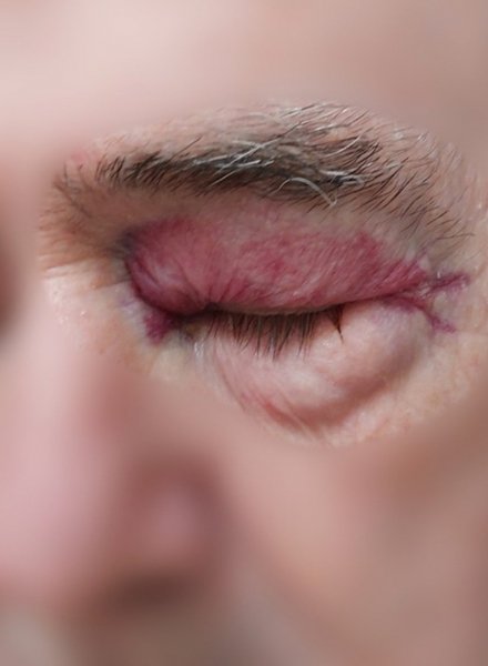 Hematoma in one of the eyes