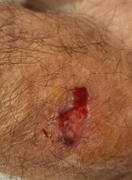 Wound on one of the arms