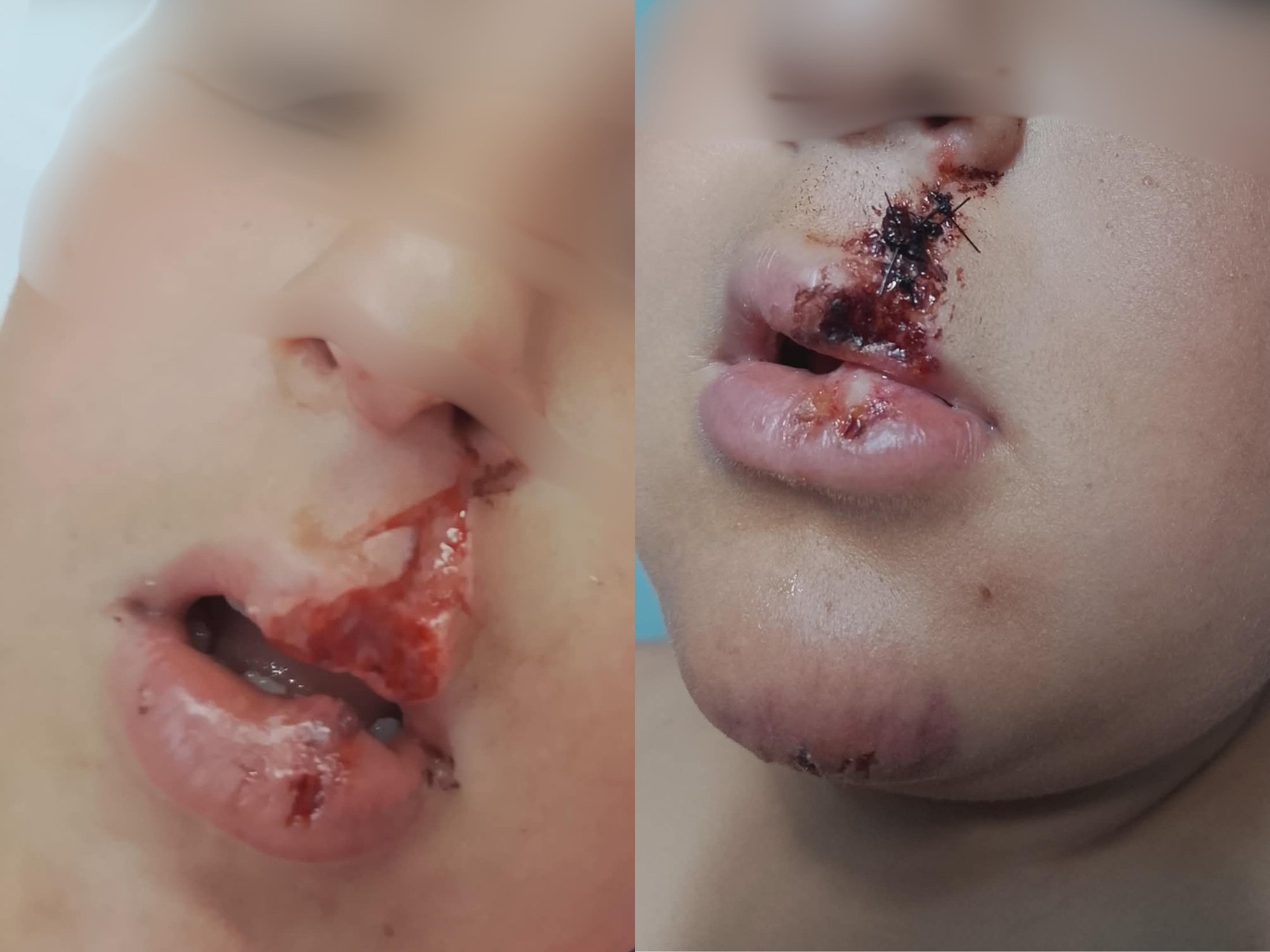 Heridas que sufrió el niño por el ataque del perro