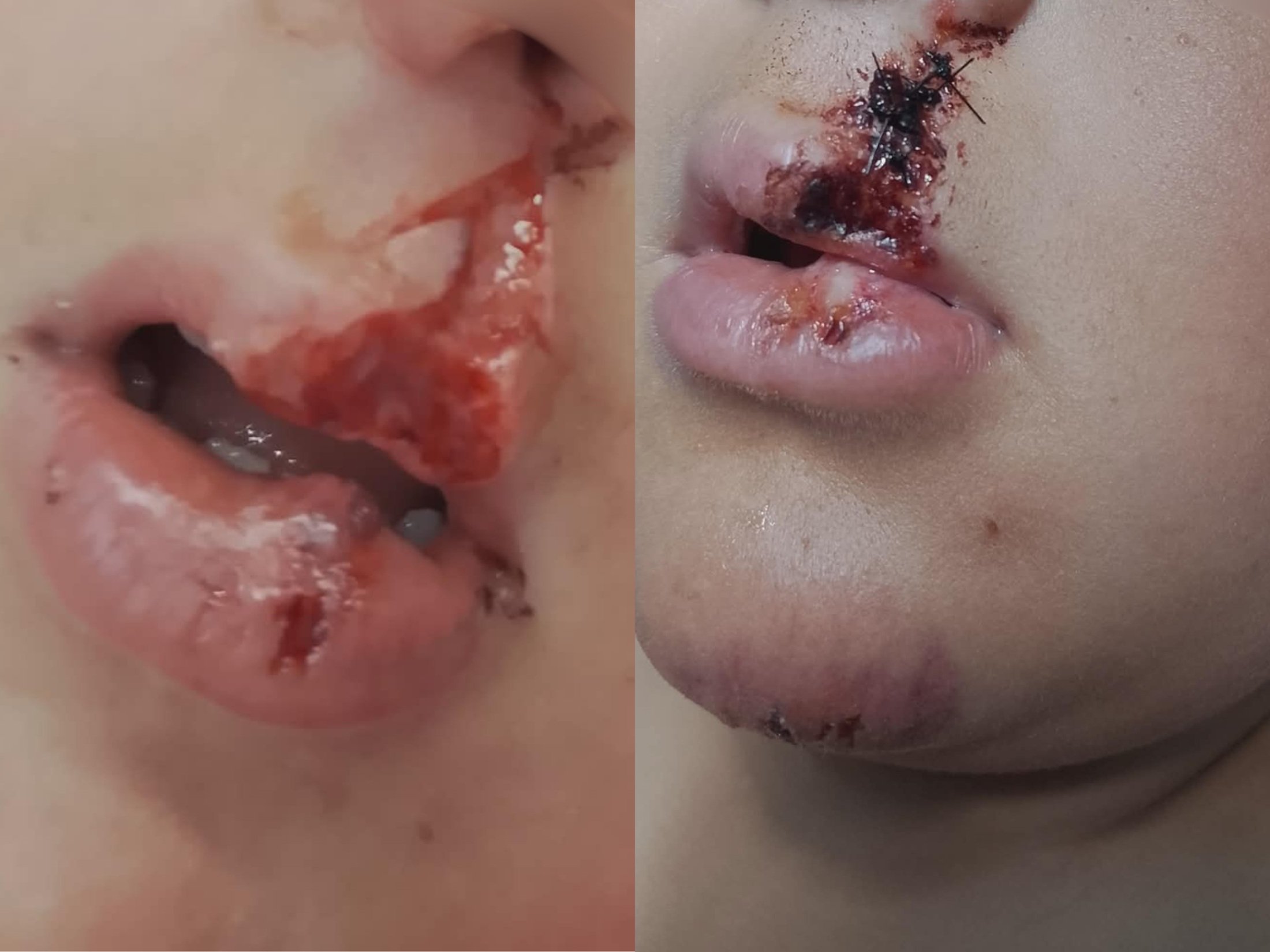 Heridas que sufrió el niño por el ataque del perro