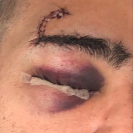 Herida del joven en el párpado