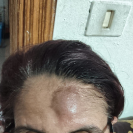 Hematoma provocado por la agresión