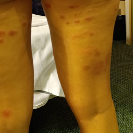 Algunas de las picaduras en las piernas de una de las turistas afectadas