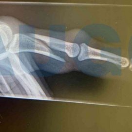 Dedo del agente agredido. Foto: AUGC.