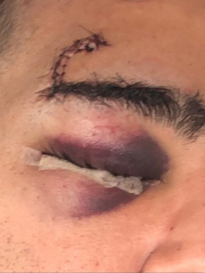 Herida del joven en el párpado